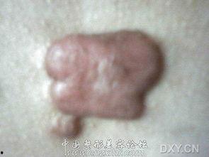 泛疙瘩图片,探寻肌肤纹理之美